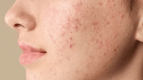 ۱۰ روش سریع و علمی برای از بین بردن جوش در یک شب