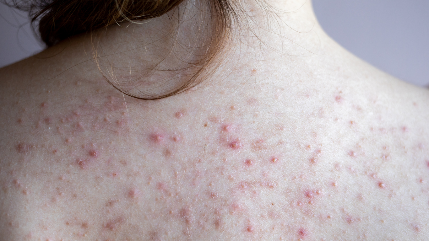 لکه‌های قرمز روی پوست: علل، درمان و نحوه خلاص شدن از شر آنها