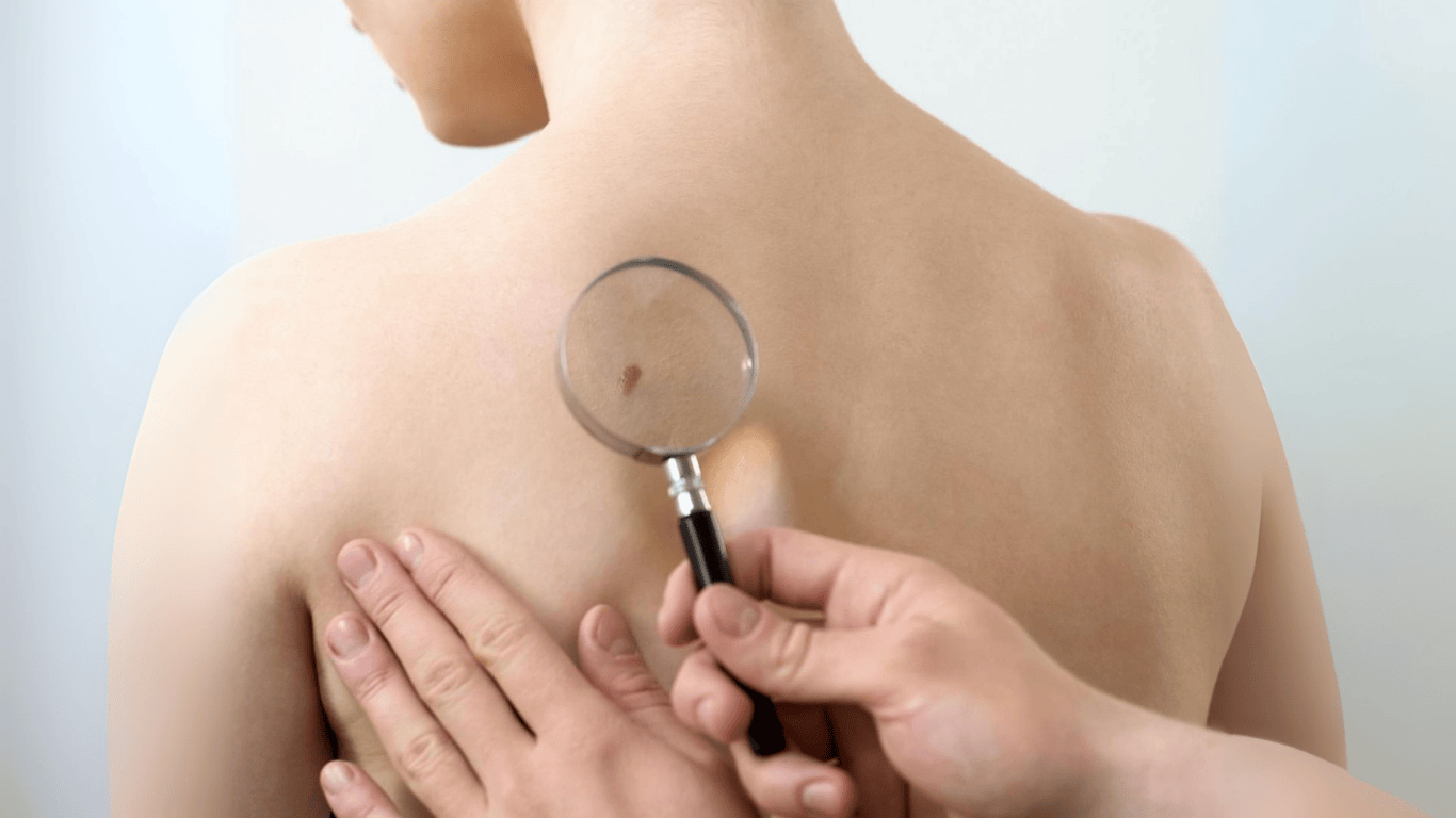 مکمل ب۳ ارزان‌قیمت می‌تواند از بازگشت سرطان پوست جلوگیری کند