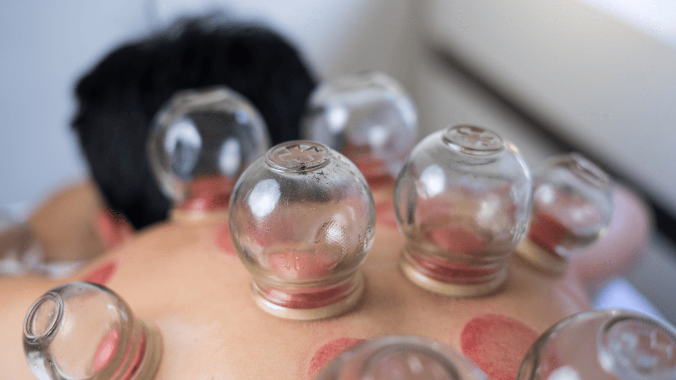 حجامت؛ روش طبیعی و مؤثر برای درمان جوش‌های صورت و مشکلات هورمونی